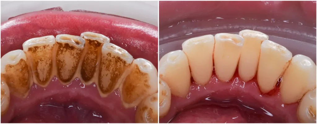 Teeth Cleaning